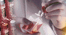Uterine Fibroid Tumor ( Myoma ) cell culture